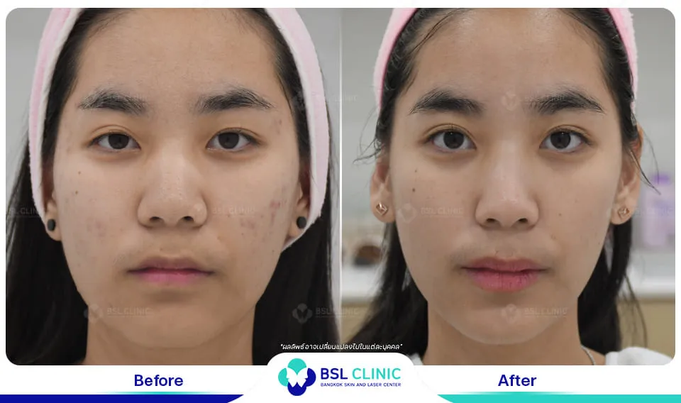 รีวิวรักษาสิว