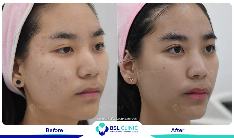 รีวิวรักษาสิว