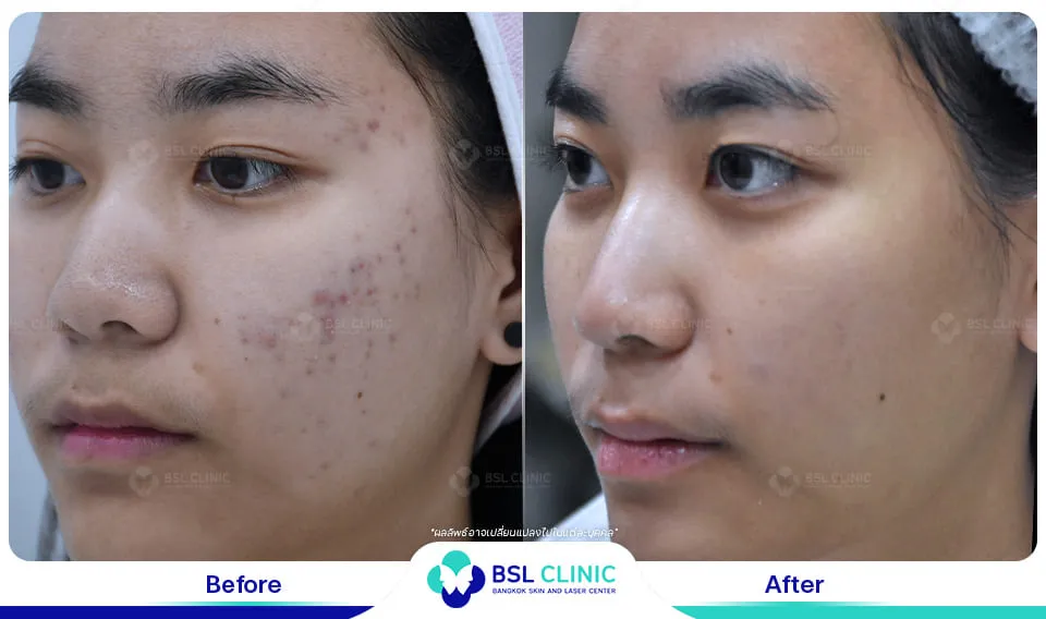 รีวิวรักษาสิว