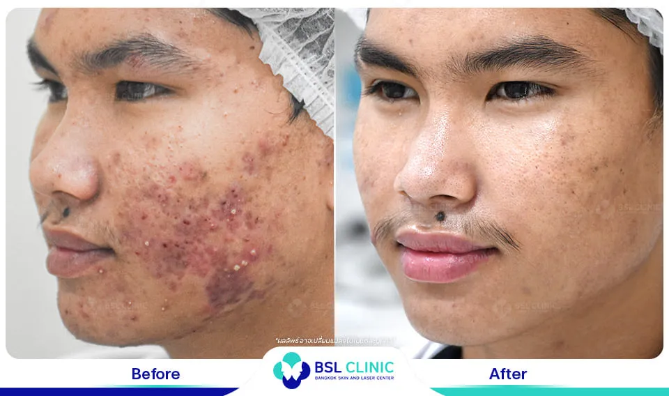 รีวิวรักษาสิว