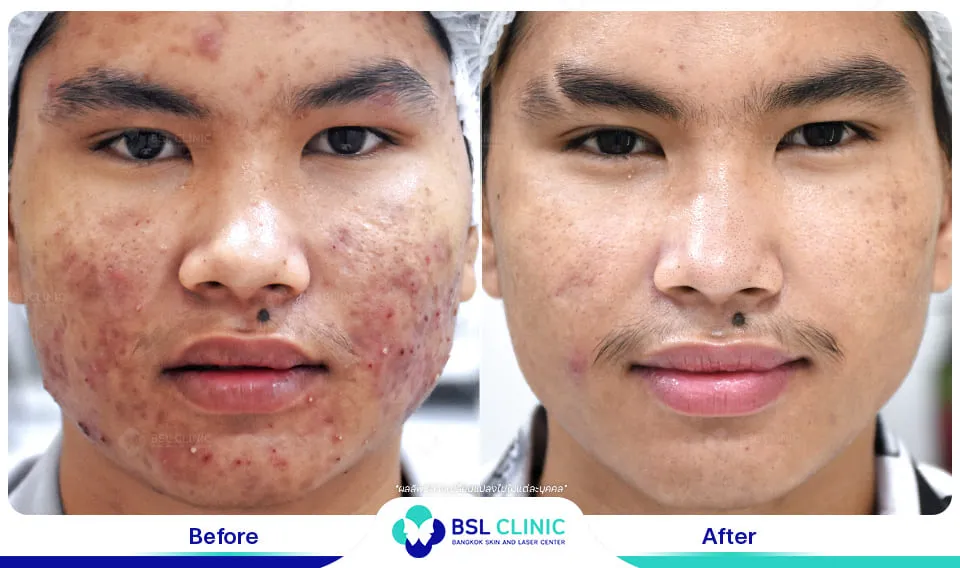 รีวิวรักษาสิว