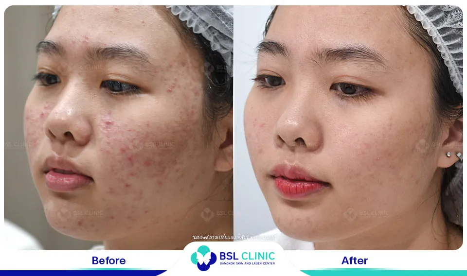 ลดรอยสิว