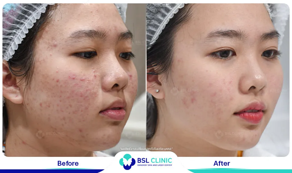 ลดรอยสิว