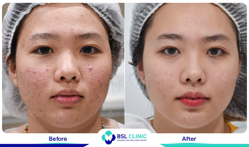 ลดรอยสิว