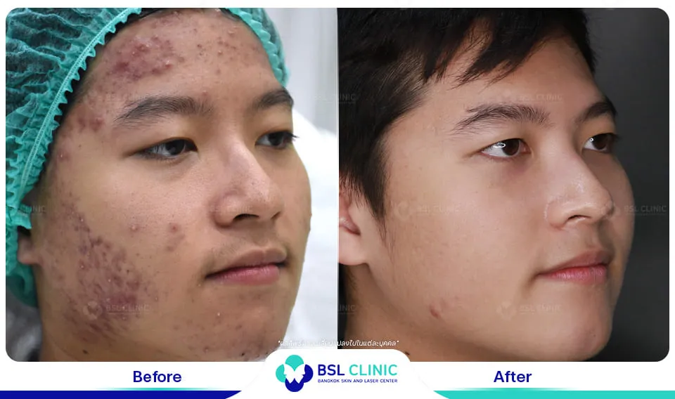 ลดรอยสิว