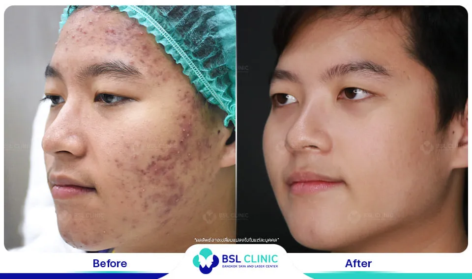 ลดรอยสิว