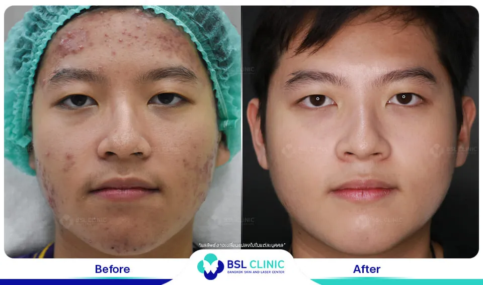 ลดรอยสิว