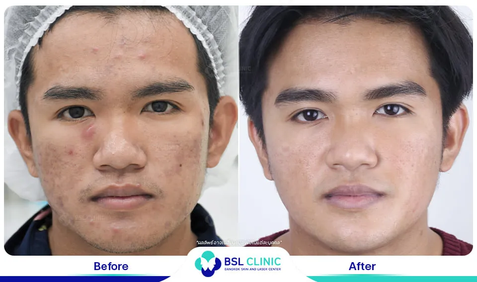 หมอรักษาสิว