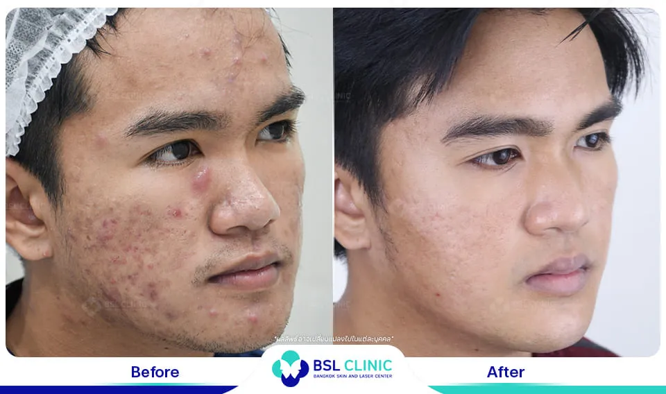 หมอรักษาสิว