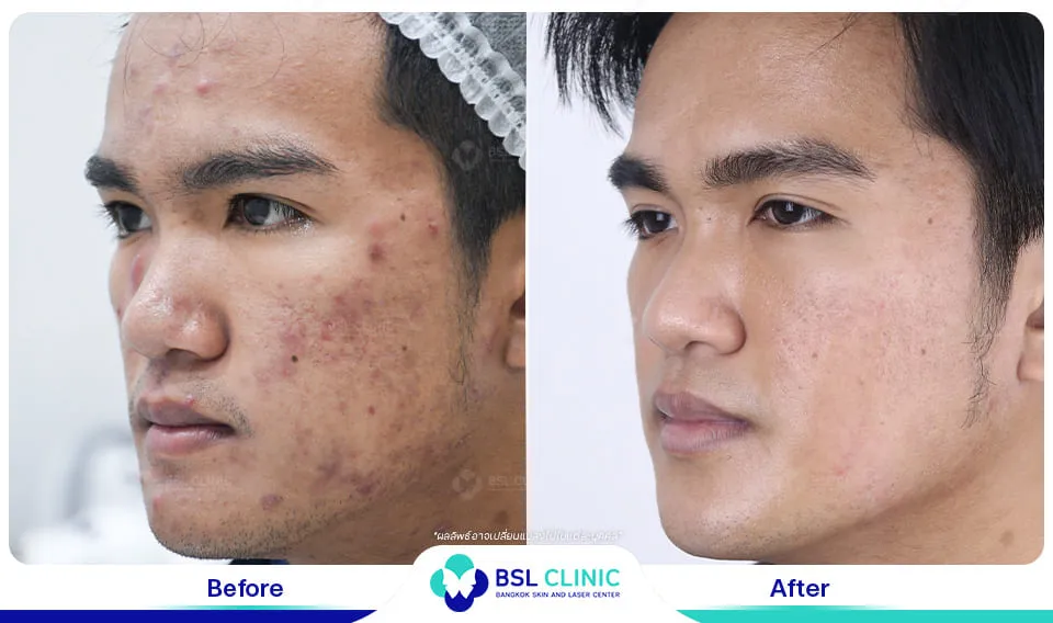 หมอรักษาสิว