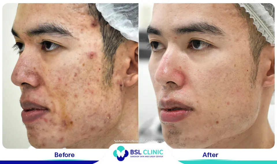 หมอรักษาสิว