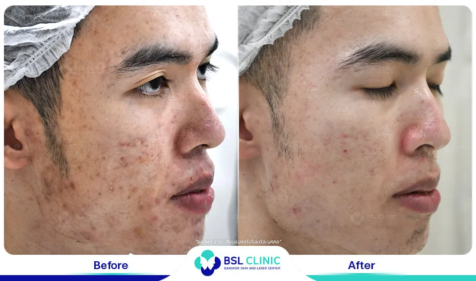 หมอรักษาสิว