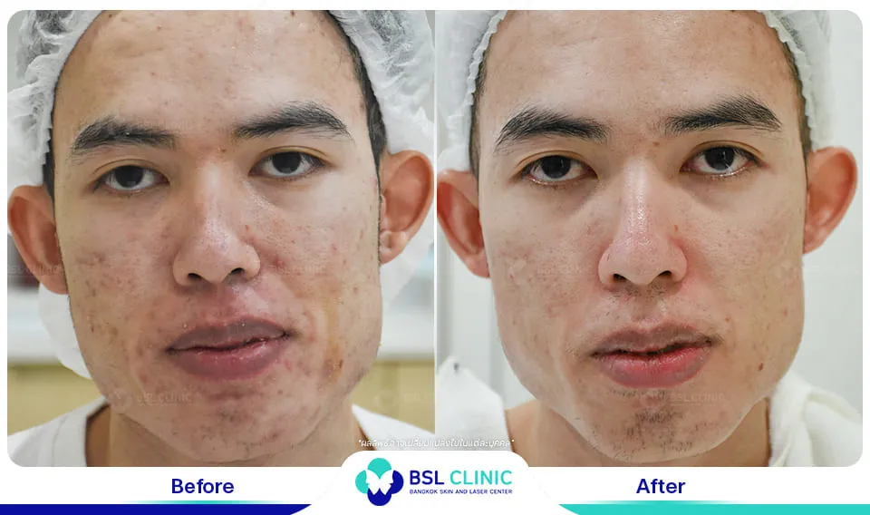 หมอรักษาสิว