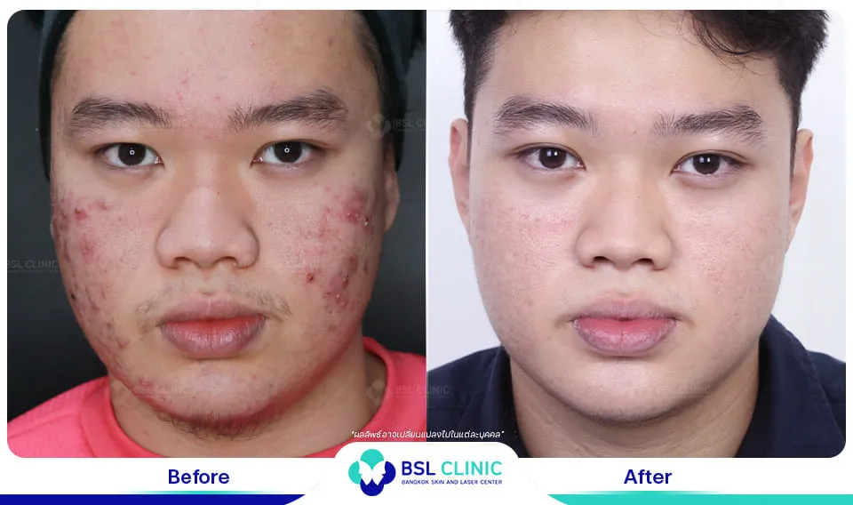 สิวอักเสบ