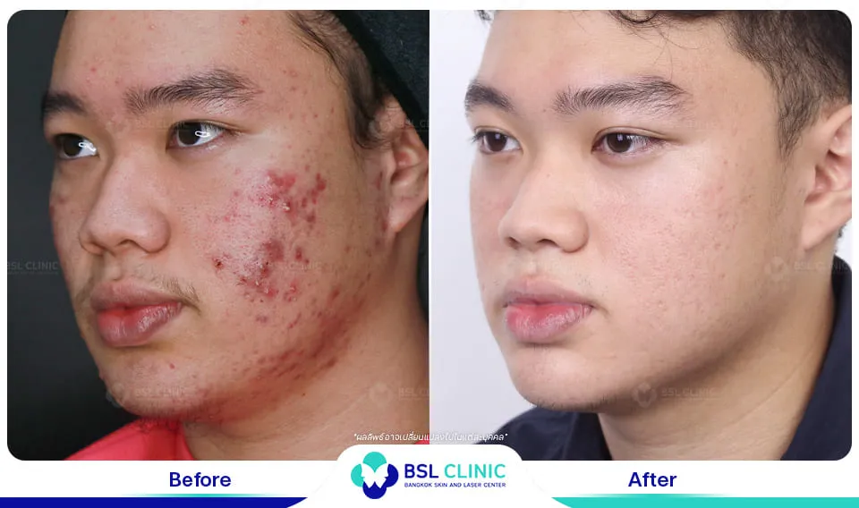 สิวอักเสบ