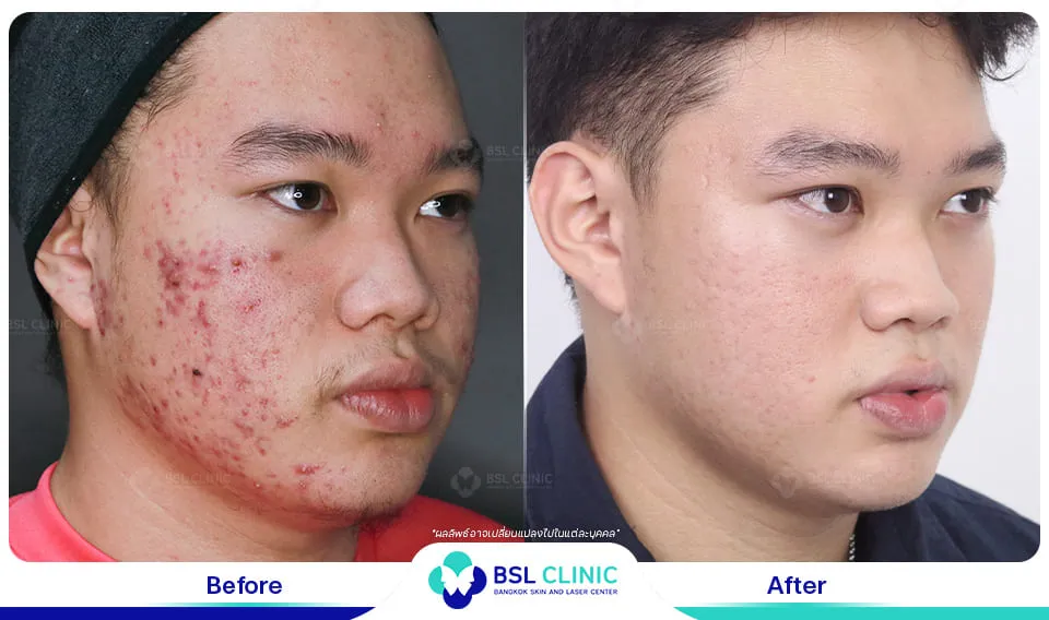 สิวอักเสบ