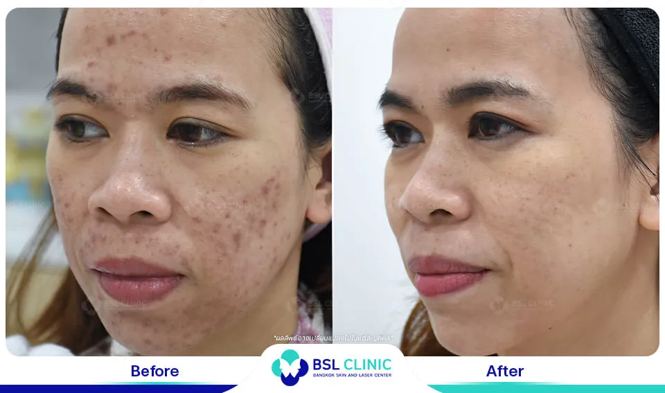 สิวอักเสบ