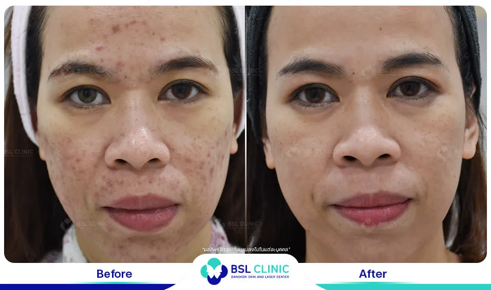 สิวอักเสบ