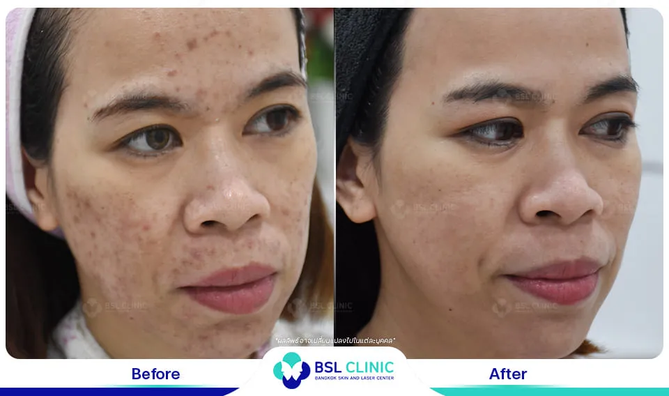 สิวอักเสบ