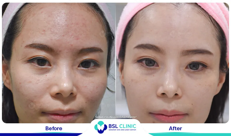 bsl clinic รักษาสิว