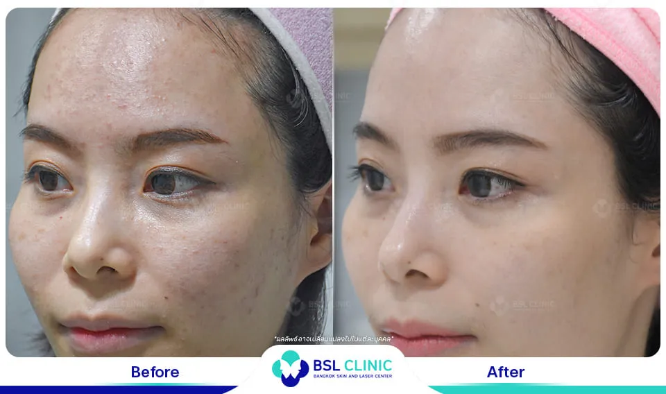 bsl clinic รักษาสิว