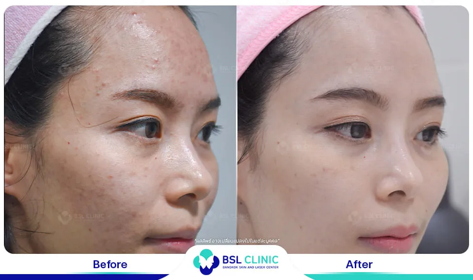 bsl clinic รักษาสิว