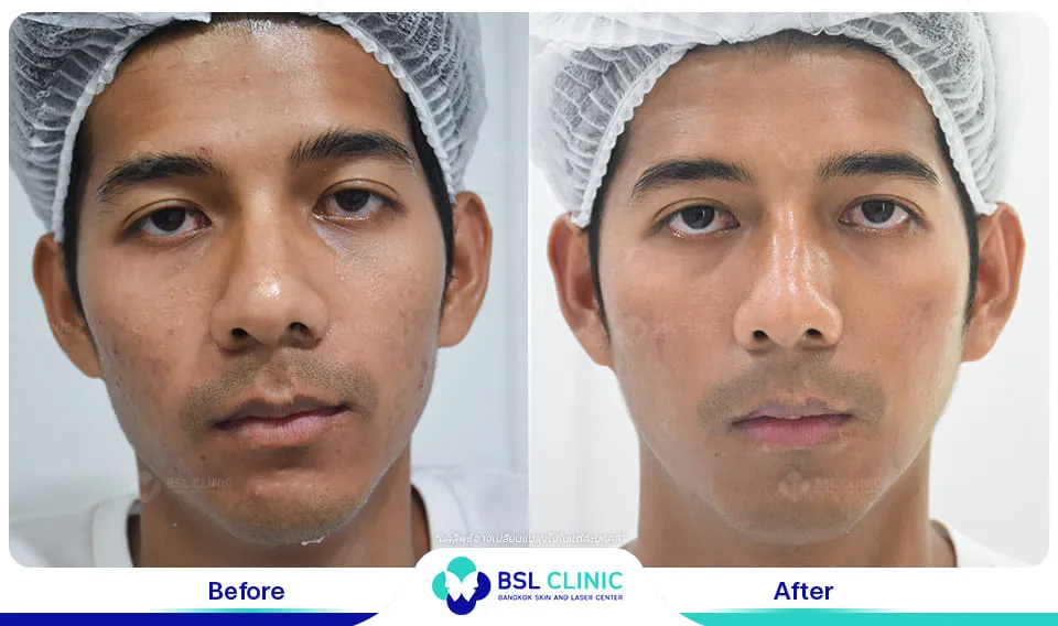 bsl clinic รักษาสิว