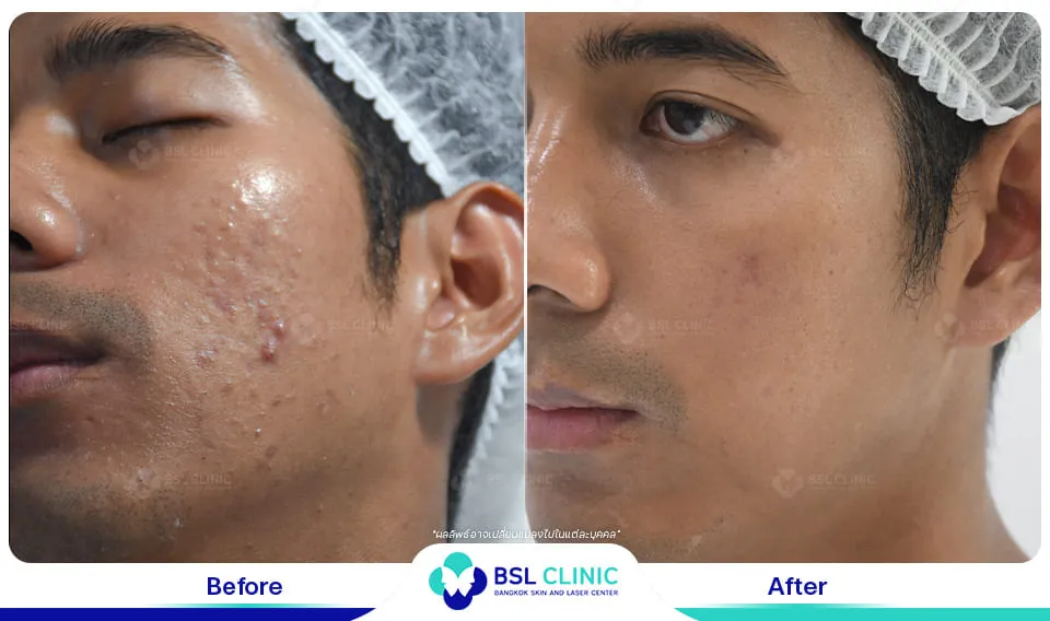 bsl clinic รักษาสิว