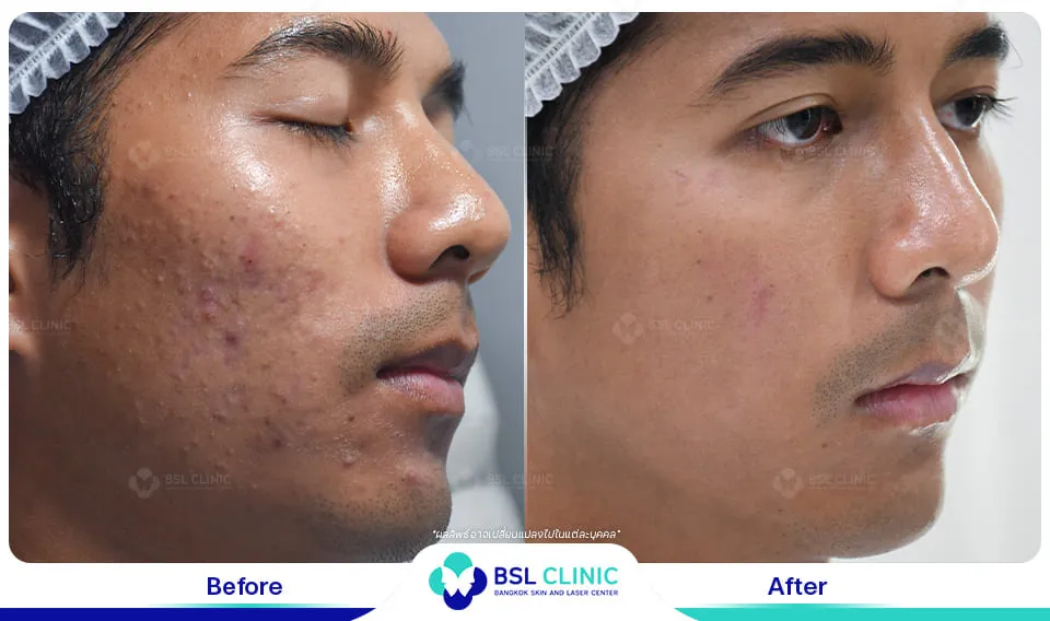 bsl clinic รักษาสิว