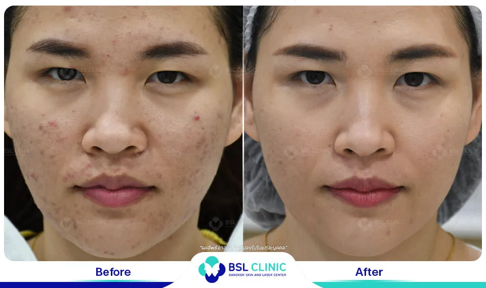 bsl clinic รักษาสิว