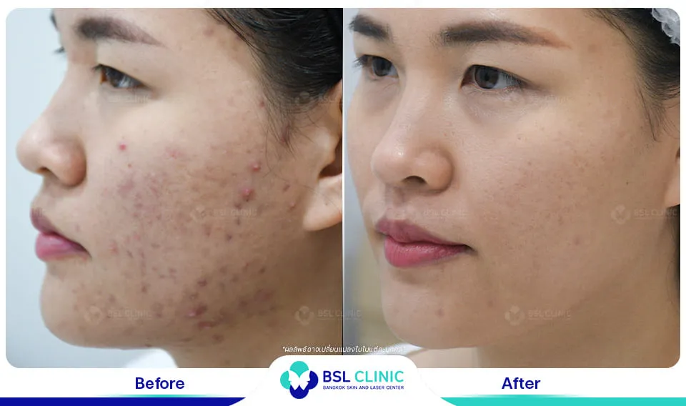 bsl clinic รักษาสิว