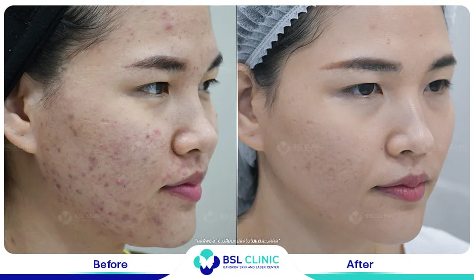 bsl clinic รักษาสิว