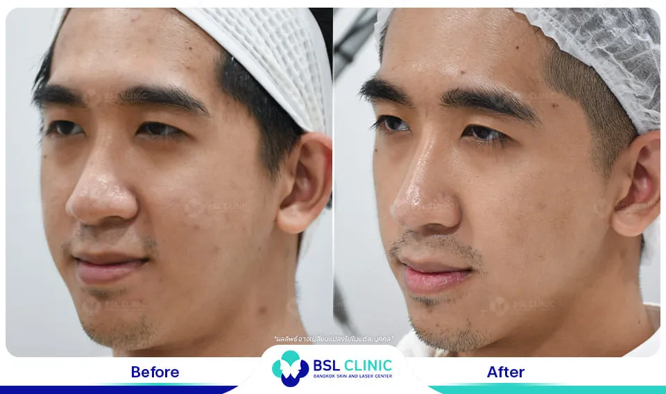 bsl clinic รักษาสิว
