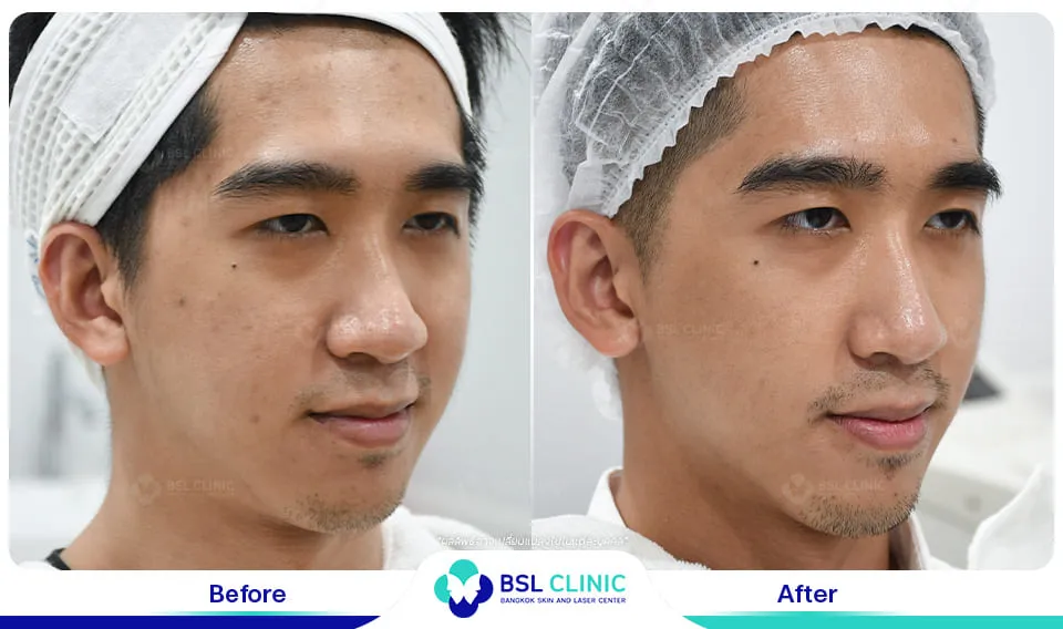 bsl clinic รักษาสิว