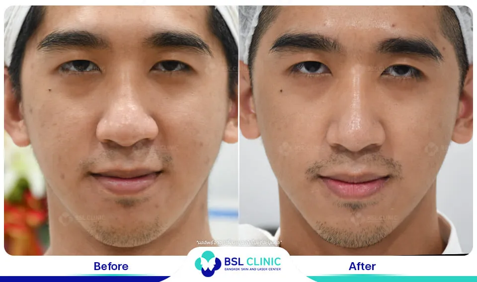 bsl clinic รักษาสิว