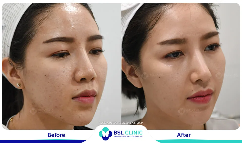 คลินิกรักษาสิวใกล้ฉัน