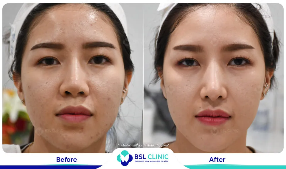 คลินิกรักษาสิวใกล้ฉัน