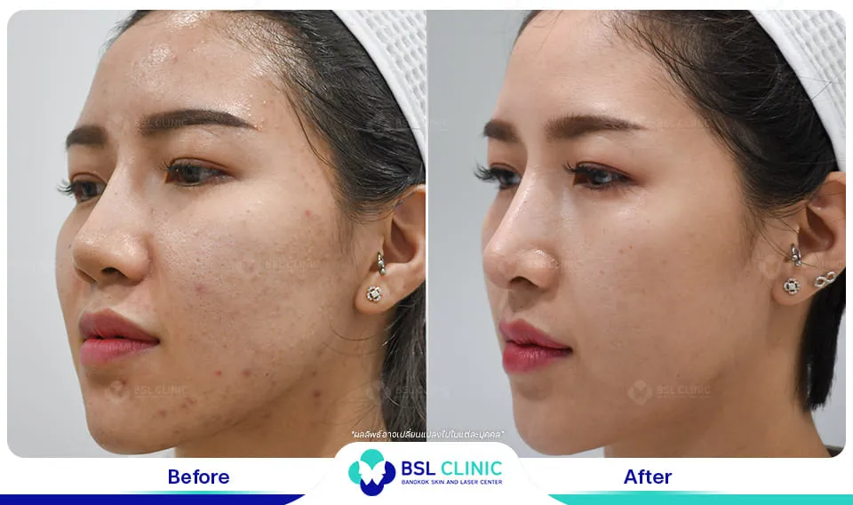 คลินิกรักษาสิวใกล้ฉัน