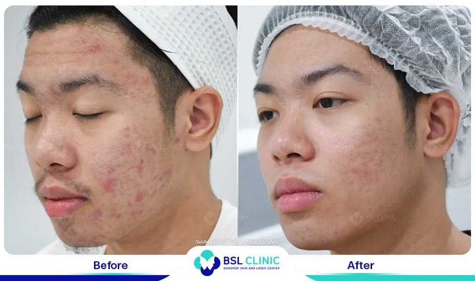 คลินิกรักษาสิวใกล้ฉัน