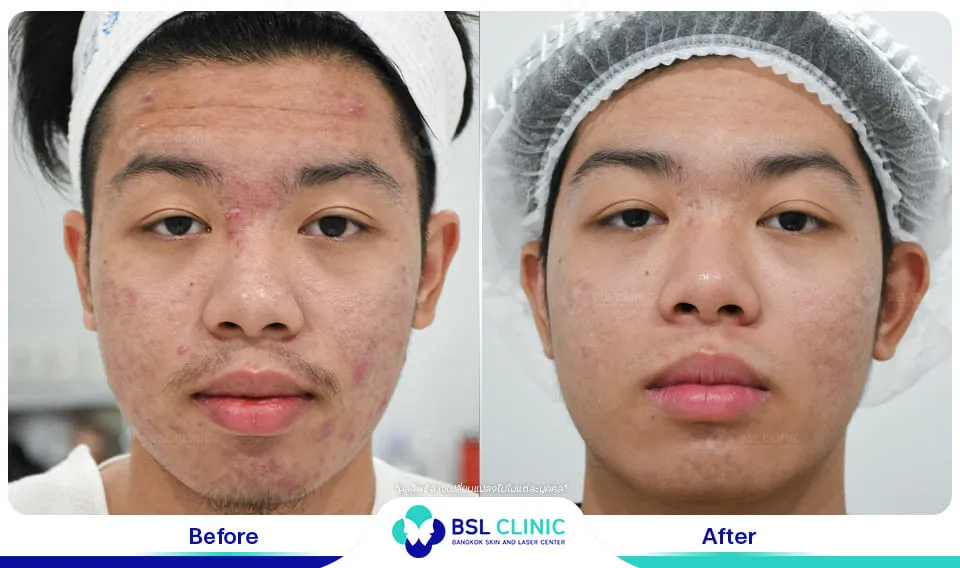 คลินิกรักษาสิวใกล้ฉัน