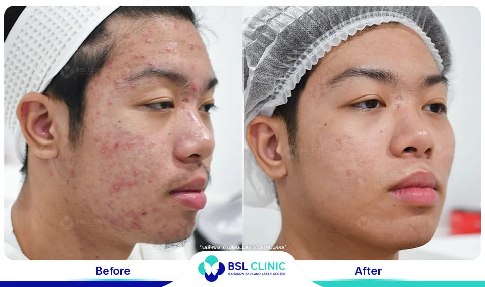 คลินิกรักษาสิวใกล้ฉัน