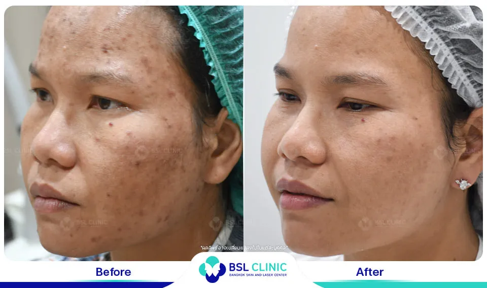 คลินิกรักษาสิวใกล้ฉัน