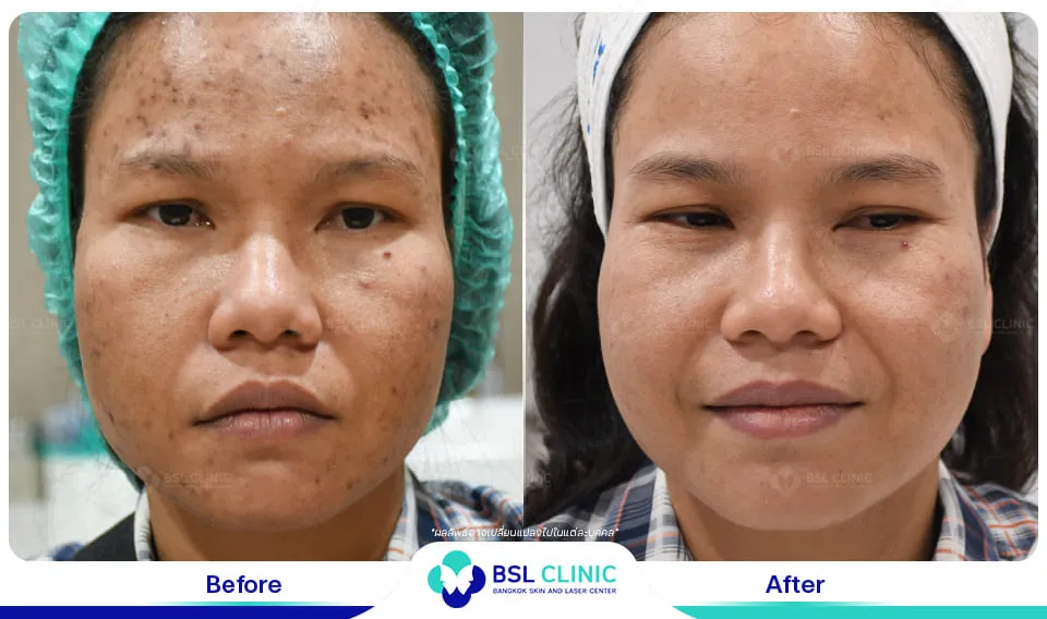 คลินิกรักษาสิวใกล้ฉัน