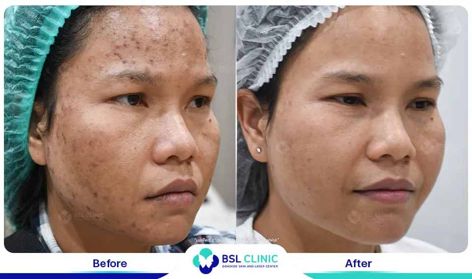 คลินิกรักษาสิวใกล้ฉัน