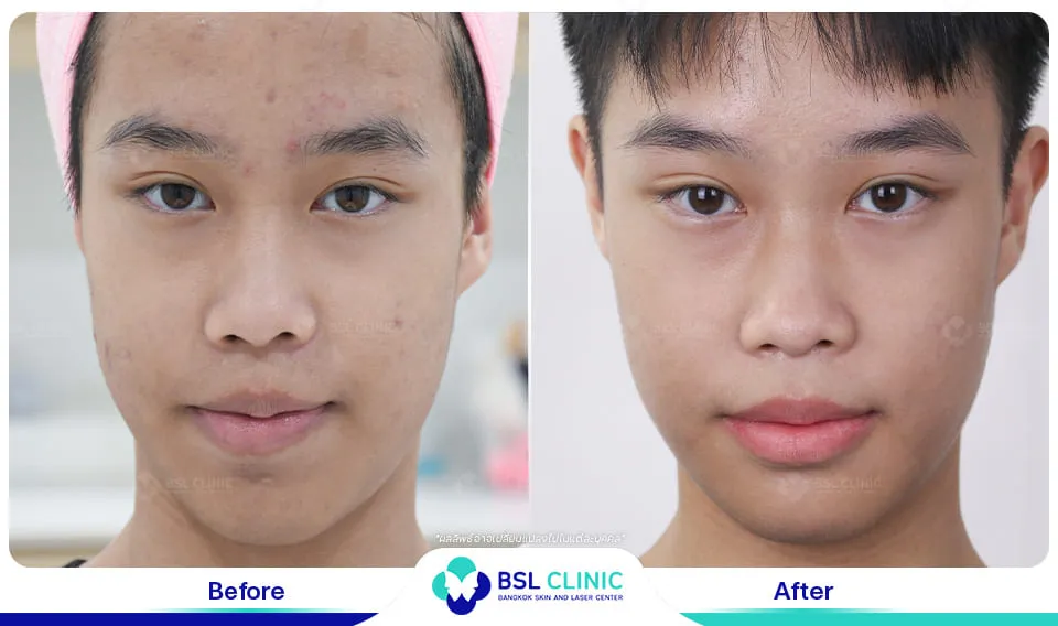 คลินิกรักษาสิวใกล้ฉัน