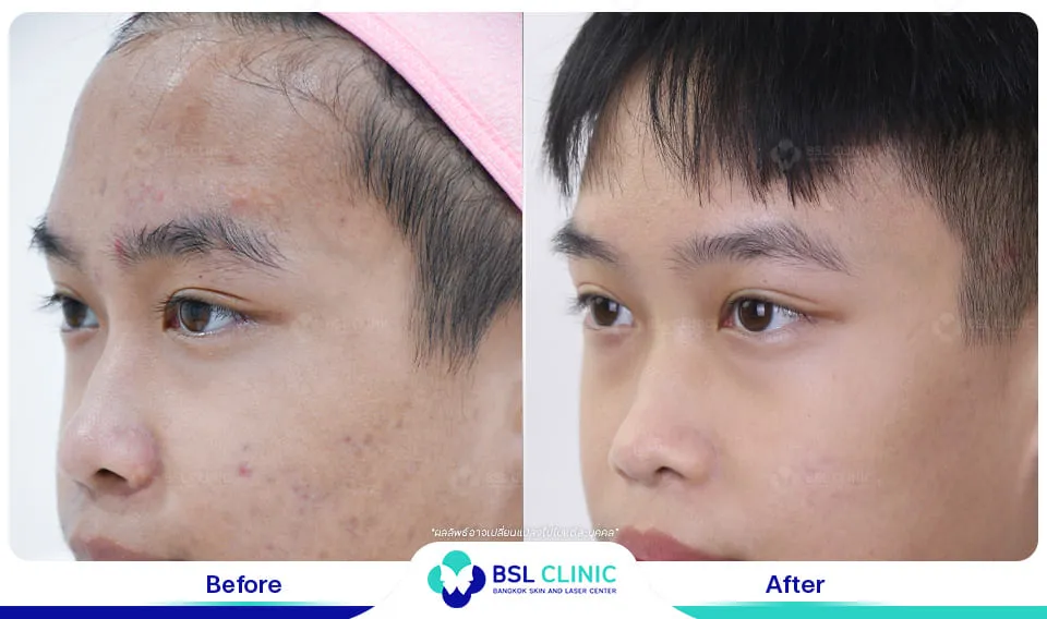 คลินิกรักษาสิวใกล้ฉัน