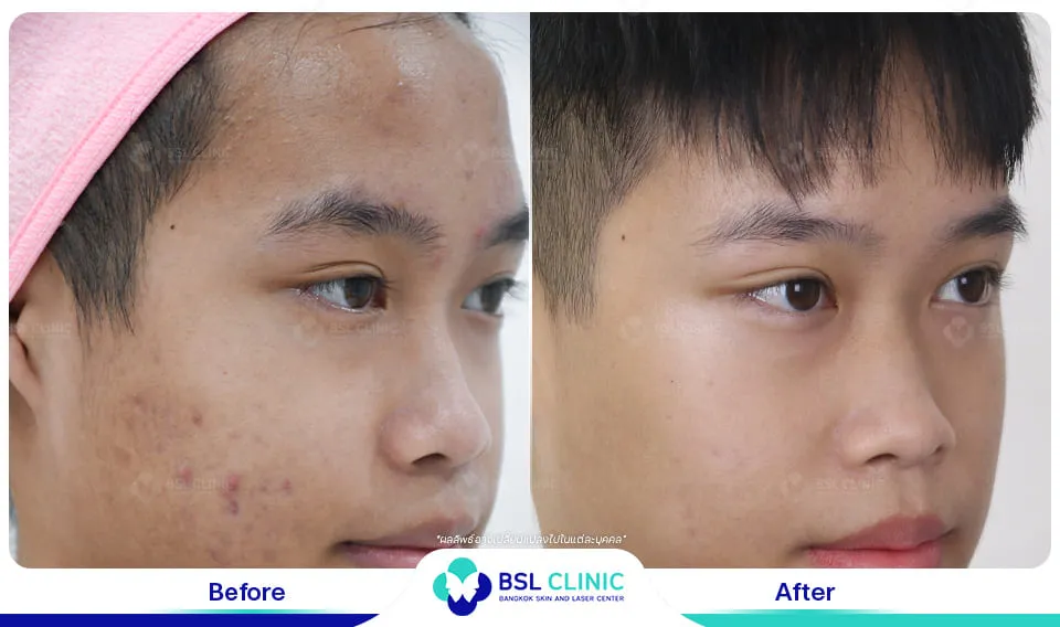 คลินิกรักษาสิวใกล้ฉัน