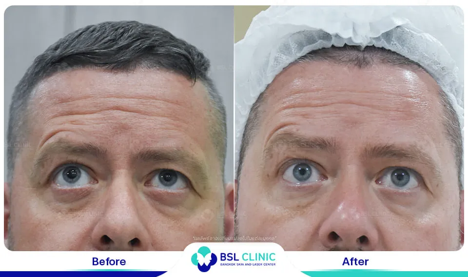 รีวิวเติมเต็มริ้วรอย