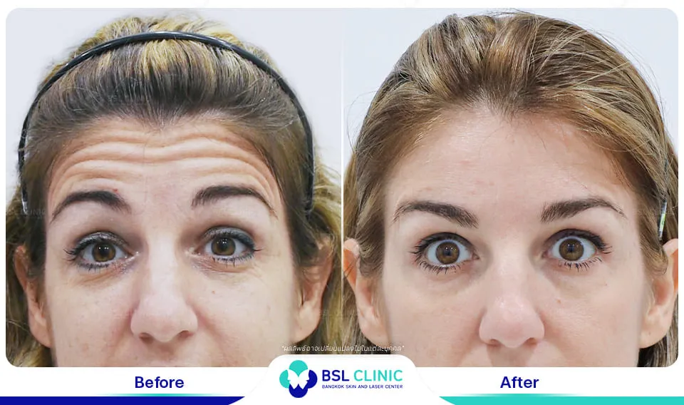 รีวิวเติมเต็มริ้วรอย