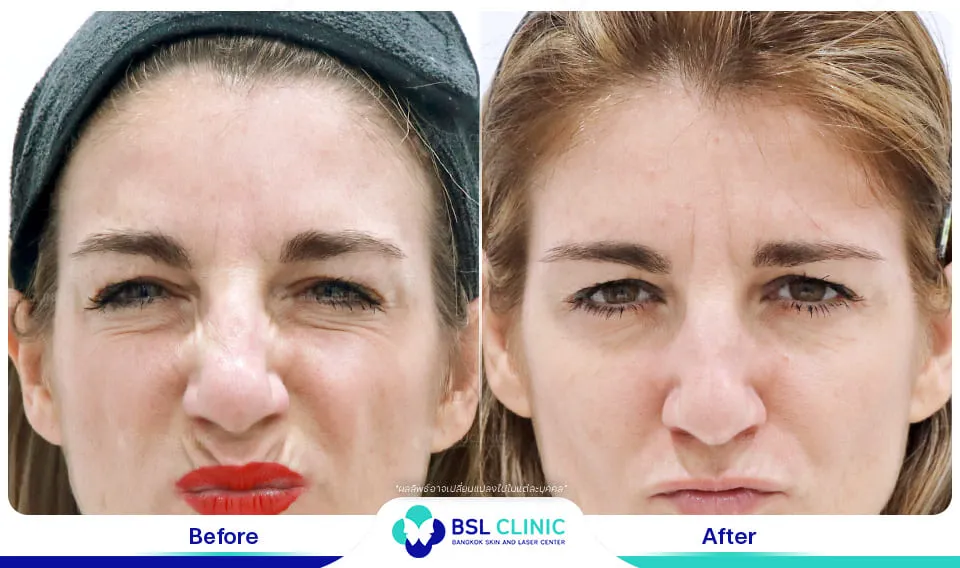 รีวิวเติมเต็มริ้วรอย